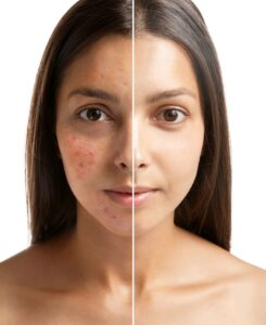 7 Home Remedies For Acne & Pimples 1